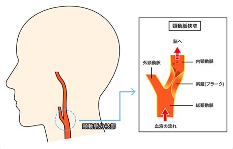 首 脈|ドックで見つかる頚動脈狭窄症って？